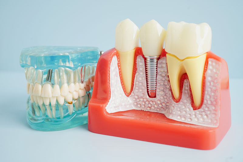 Unveiling the Mystery of Implant Dentistry Treatments