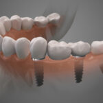 some dental implants with a crown on top of the implants