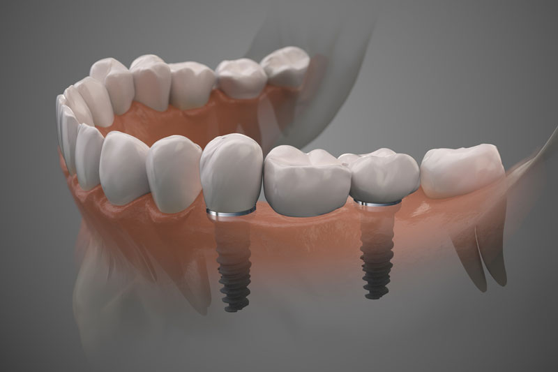 Unraveling the Mysteries of Full Mouth Dental Implants in Gladstone, OR