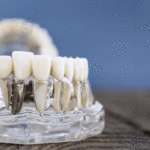 Dental Implant Model Showcasing Prosthetic Teeth on a Transparent Jaw for Educational